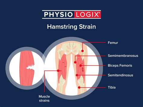 Hamstring Injury Recovery How Long Does A Pulled Hamstring Take To