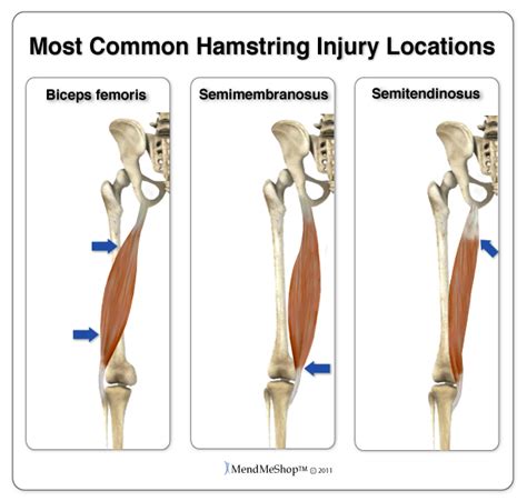 Hamstring Strain Information