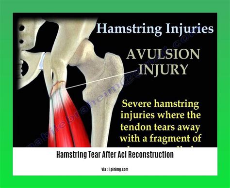 Hamstring Tears After ACL Reconstruction Management and Prevention
