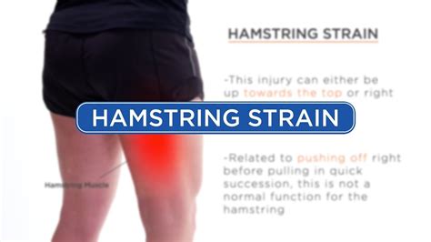 Hamstring Muscle Injuries. Hamstring muscle injuries — s