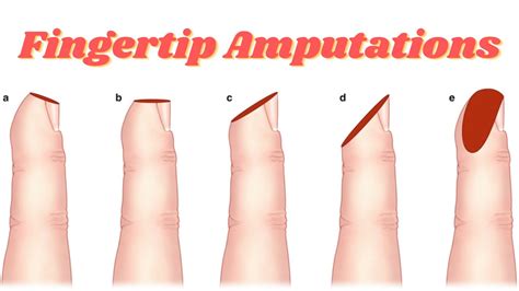 Hand⎪Fingertip Amputations & Finger Flaps – The Orthobullets …