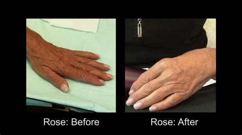 Hand Rejuvenation Videos - RealSelf