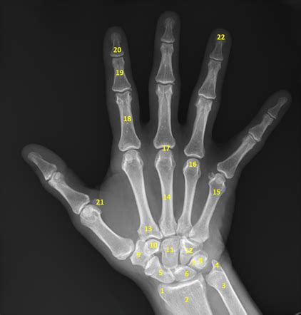 Hand series Radiology Reference Article Radiopaedia.org