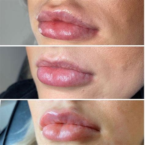 Has My Lip Filler Migrated? Are My Lips Normal? L1P