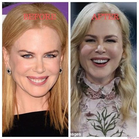 Has Nicole Kidman Had Plastic Surgery? - Celeb Answers