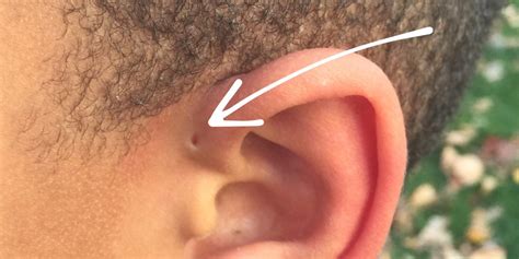 Have you seen someone with a ‘Tiny Hole’ above their ears?