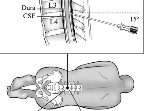 Healing Dura And Therapies For CSF Leaks - MyBioHack