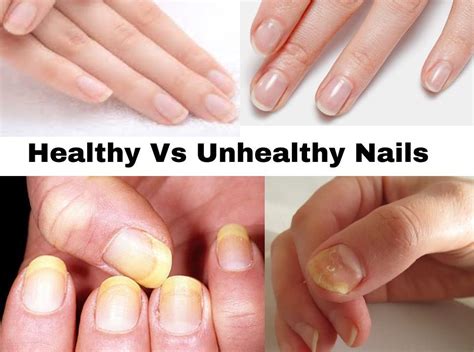 Healthy nails vs unhealthy pictures.  Less Searching, More Finding With Getty Images. ...