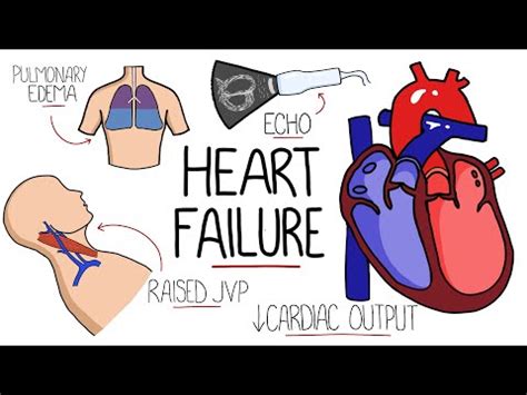 Heart Failure Explained - HFrEF vs HFpEF (Systolic vs ... - YouTube