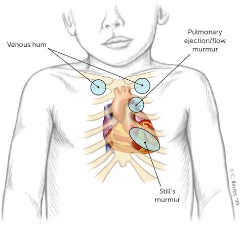 Heart murmur in babies What is it causes and more