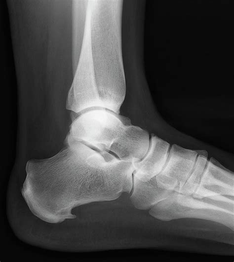 Heel Bone Spur Photograph by Zephyr/science Photo Library Pixels