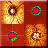 Heidelberg Retinal Tomography Department of Ophthalmology