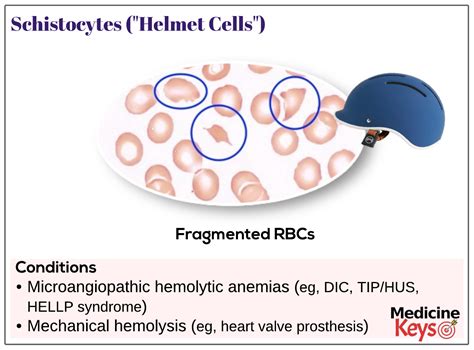 Helmet cell definition of helmet cell by Medical dictionary