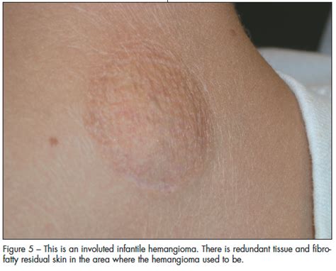 Hemangiomas: Distinguishing Between Various Types of …