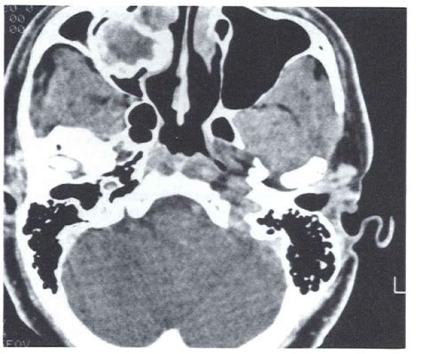 Hemangiomas of the nasal septum and paranasal sinuses