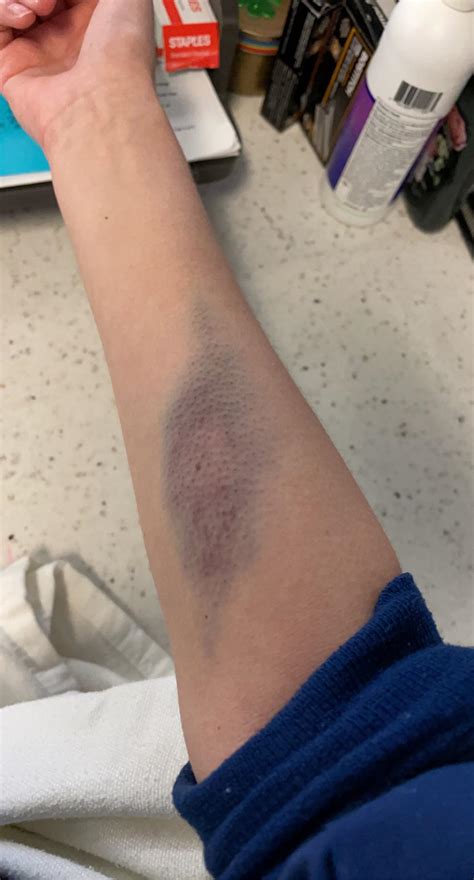 Hematoma After Blood Draw