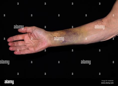 Hematoma on arm pictures. A possible injury like a broken bone that caused the bruise. Bleeding that doesn't stop after a few minutes. Signs of too much blood loss, such as weakness, dizziness, nausea, or extreme thirst ... 