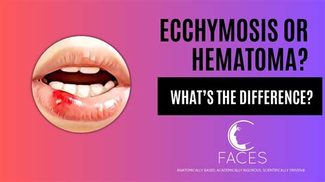 Hematoma vs Ecchymosis - What