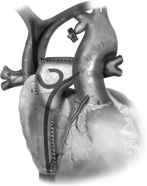 HemiFontan Procedure Operative Techniques in Thoracic and
