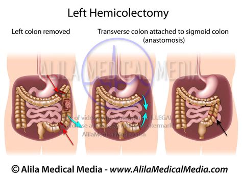 Hemicolectomy