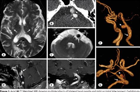 Hemifacial spasm and recurrent stroke due to vertebrobasilar ...