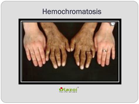 Hemochromatosis: The Danger of Too Much Iron in Your Blood …