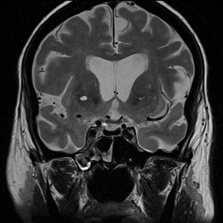 Hemochromatosis (CNS manifestations) Radiology …