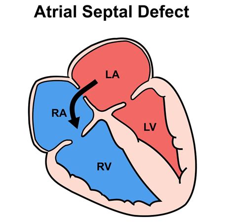 Hemodynamic assessment of atrial septal defects - PubMed