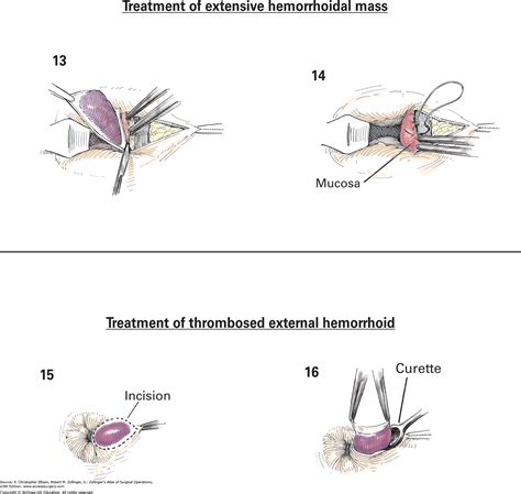 Hemoroidektomi