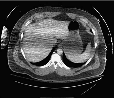 Hemorrhage intra-abdominal Article about hemorrhage intra …