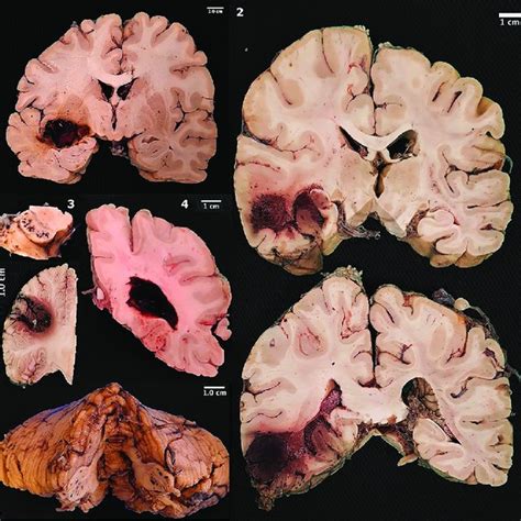 Hemorrhage pathology Britannica