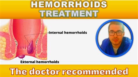 Hemorrhoid with white tip- 378 Questions Answered Practo …