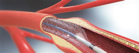 Heparin coated coronary artery stent - UF Health