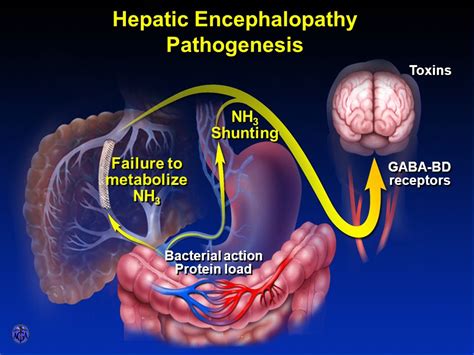 Hepatic Encephalopathy Nursing Management - RNpedia