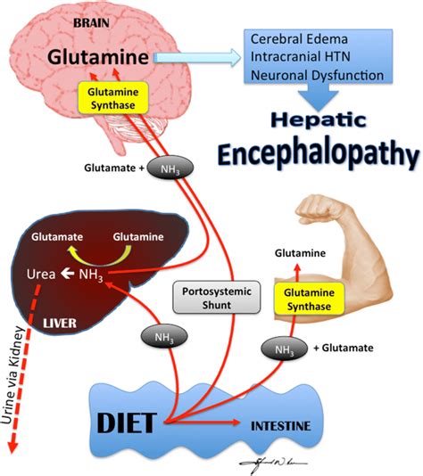 Hepatic Encephalopathy in Chronic Liver Disease