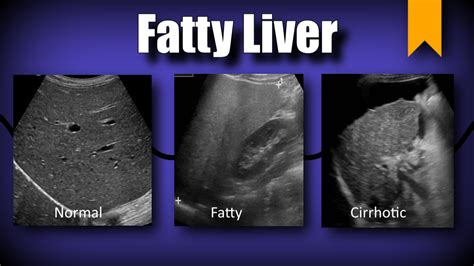 Hepatic Steatosis (Fatty Liver) – Sonographic Tendencies