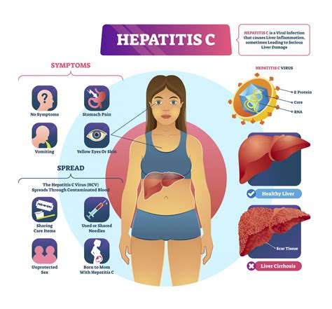 Hepatitis C; Modes of transmission, Prevention, Symptoms,