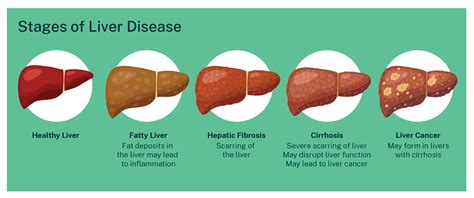 Hepatitis C: What happens in end-stage liver disease?