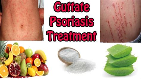 Herbal medicine complete guide natural cure for psoriasis and wound. - Manuale di servizio kia sportage torrent.