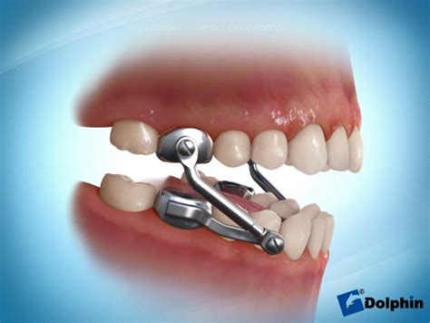 Herbst Appliance - Brace Yourself Orthodontics