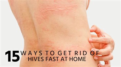 Here’s How to Crack the Itchy Cycle of Hives Banner Health