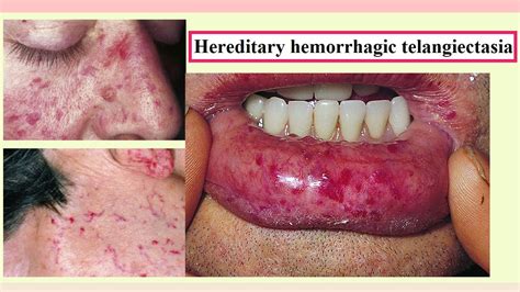 Hereditary Haemorrhagic Telangiectasia The BMJ