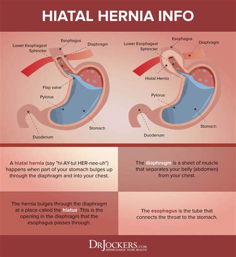 Hernia fluid? : r/Hernia - Reddit