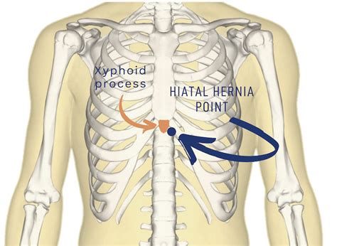 Hernia under ribs on left side. Unlike an abdominal (or groin) hernia, a hiatus hernia occurs in the chest area and affects the digestive system. Where the oesophagus (the “gullet” – connecting the mouth with the stomach) goes down, it passes the diaphragm through a gap called the hiatus. Immediately below that, it goes into the stomach which sits just below the diaphragm. 