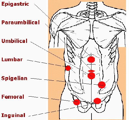 Hernia under ribs on right side. Besides a visible bulge, incisional hernias might also cause: nausea and vomiting. fever. burning or aching near the hernia. abdominal pain and discomfort, particularly around the hernia. faster ... 