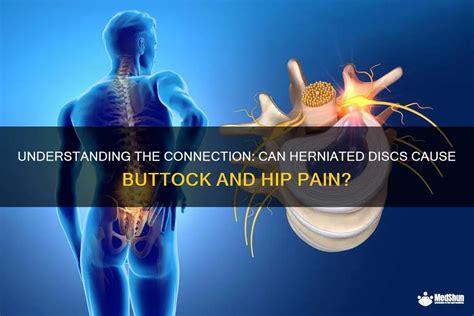 Herniated Disc Buttocks Pain - Herniated Disc