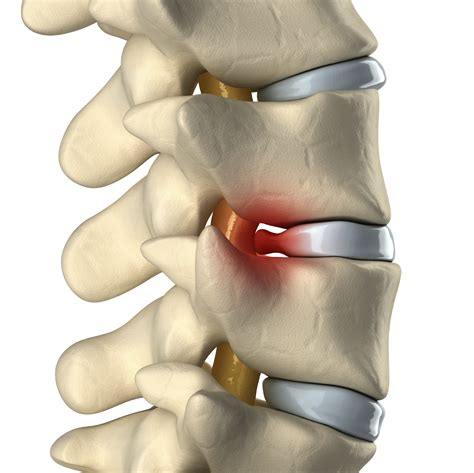 Herniated Disc Michigan Medicine - U of M Health