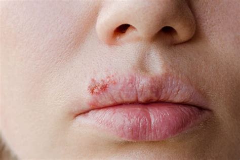 Herpes female pictures. Family naturalist photography is a great way to capture the beauty of nature and the special moments with your family. With a few simple tips, you can make sure that your family na... 
