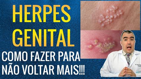 Herpes genital tem cura? Tem sim! Mais simples do que pensa!