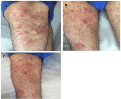 Herpes on thighs pictures. In men, the most common locations are the penis, scrotum, upper thighs, buttocks, and anus. Primary genital HSV infection can be severe, with many painful blisters causing pain and burning with urination and vaginal or urethral discharge. People may also develop fever, headaches, muscle aches, and fatigue with a primary outbreak. 